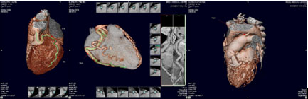 MSCT_64_in_ALCAPA_syndrome-h2
