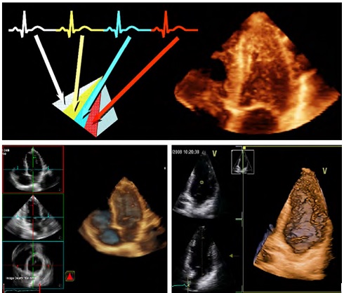 Lappe Hold op redaktionelle Siêu âm tim 3 chiều trong chẩn đoán bệnh tim mạch | Tim mạch học