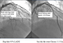 stent-MinhTuan