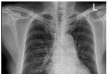 Viêm động mạch chủ do nhiễm trùng – Ca lâm sàng và tổng quan y văn – P1