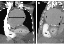 Viêm động mạch chủ do nhiễm trùng – Ca lâm sàng và tổng quan y văn – P2