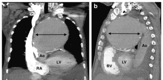 Viêm động mạch chủ do nhiễm trùng – Ca lâm sàng và tổng quan y văn – P2