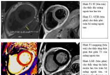 Viêm màng ngoài tim cấp – Từ lâm sàng đến hình ảnh học