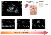 Quan điểm mới về đánh giá áp lực đổ đầy và quá tải dịch trong suy tim