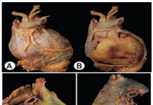 Bệnh màng ngoài tim và các biện pháp thực hành tốt cho phẫu thuật cắt bỏ màng ngoài tim