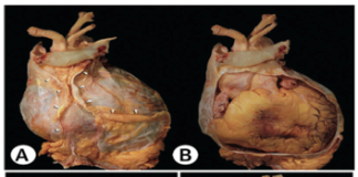 Bệnh màng ngoài tim và các biện pháp thực hành tốt cho phẫu thuật cắt bỏ màng ngoài tim