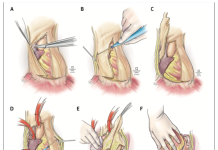 Bệnh màng ngoài tim (MNT) và những quan tâm trong thực hành phẫu thuật cắt bỏ màng ngoài tim