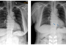 Xử trí dị vật buồng tim: Nhân một trường hợp lâm sàng