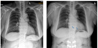 Xử trí dị vật buồng tim: Nhân một trường hợp lâm sàng