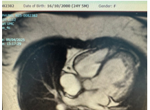 Bệnh cơ tim thể xốp với biểu hiện suy tim ở người lớn: Báo cáo hai trường hợp