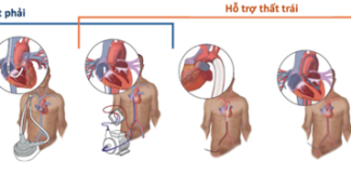 Hỗ trợ tuần hoàn cơ học ở bệnh nhân sốc tim