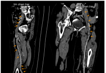 Tổng quan y văn về hội chứng May–Thurner và ca lâm sàng minh họa (Huyết khối tĩnh mạch sâu chi dưới do MTS)
