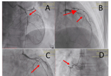 Cá thể hóa điều trị chống đông trong nhồi máu cơ tim st chênh lên ở bệnh nhân cao tuổi kèm bệnh thận mạn: Bài học từ một trường hợp lâm sàng