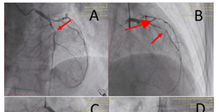 Cá thể hóa điều trị chống đông trong nhồi máu cơ tim st chênh lên ở bệnh nhân cao tuổi kèm bệnh thận mạn: Bài học từ một trường hợp lâm sàng