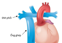 Nhồi máu não ở bệnh nhân sau phẫu thuật Fontan: Báo cáo ca lâm sàng và bàn luận về chiến lược kháng đông