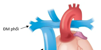 Nhồi máu não ở bệnh nhân sau phẫu thuật Fontan: Báo cáo ca lâm sàng và bàn luận về chiến lược kháng đông