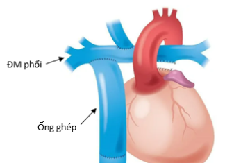 Nhồi máu não ở bệnh nhân sau phẫu thuật Fontan: Báo cáo ca lâm sàng và bàn luận về chiến lược kháng đông