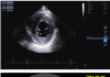 Amyloidosis tim thể Attr
