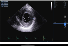 Amyloidosis tim thể Attr