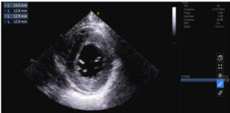 Amyloidosis tim thể Attr
