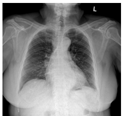 Hạ Natri máu kéo dài liên quan carbamazepine ở người cao tuổi điều trị đau dây thần kinh tam thoa