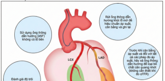 Thực hành dựa trên bằng chứng trong phòng thông tim: Đánh giá xâm lấn sinh lý mạch vành thượng tâm mạc – P2
